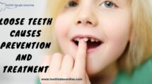 Loose Teeth Causes, Prevention, and Treatment