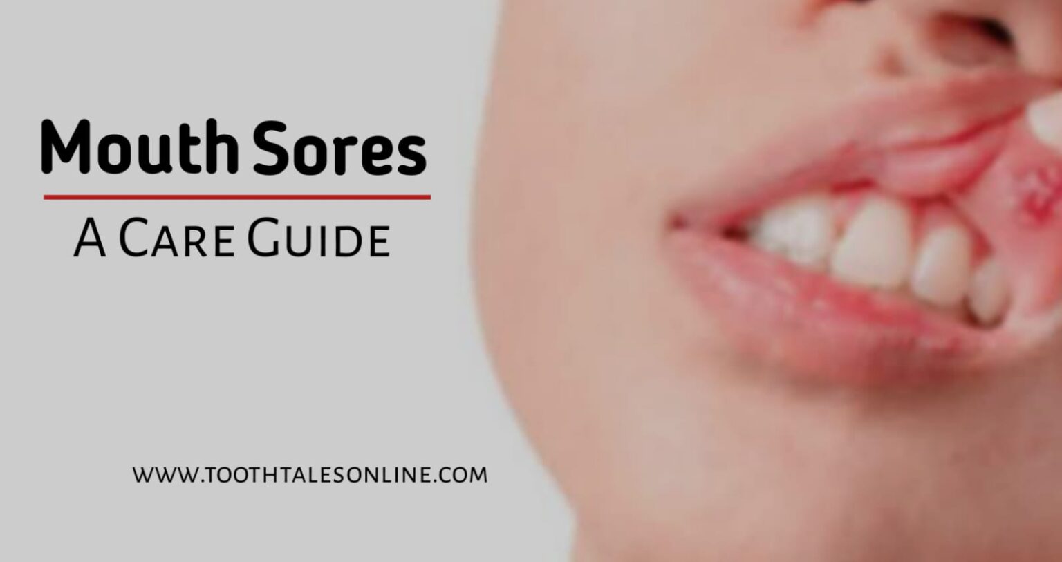 Understanding Mouth Sores Causes Symptoms And Home Remedies Toothtalesonline 1569